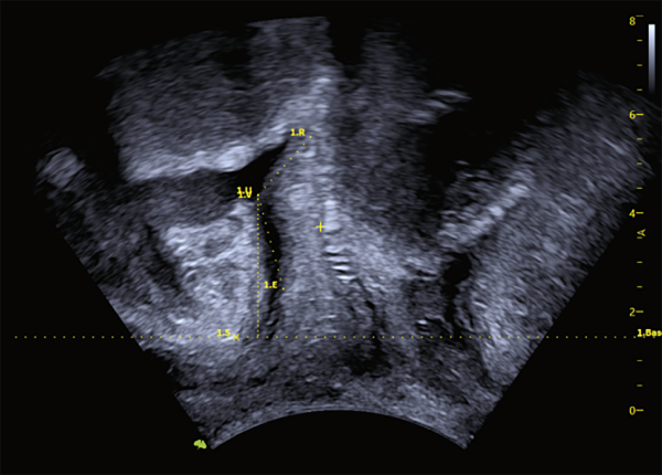 VAim Ant Pelvic